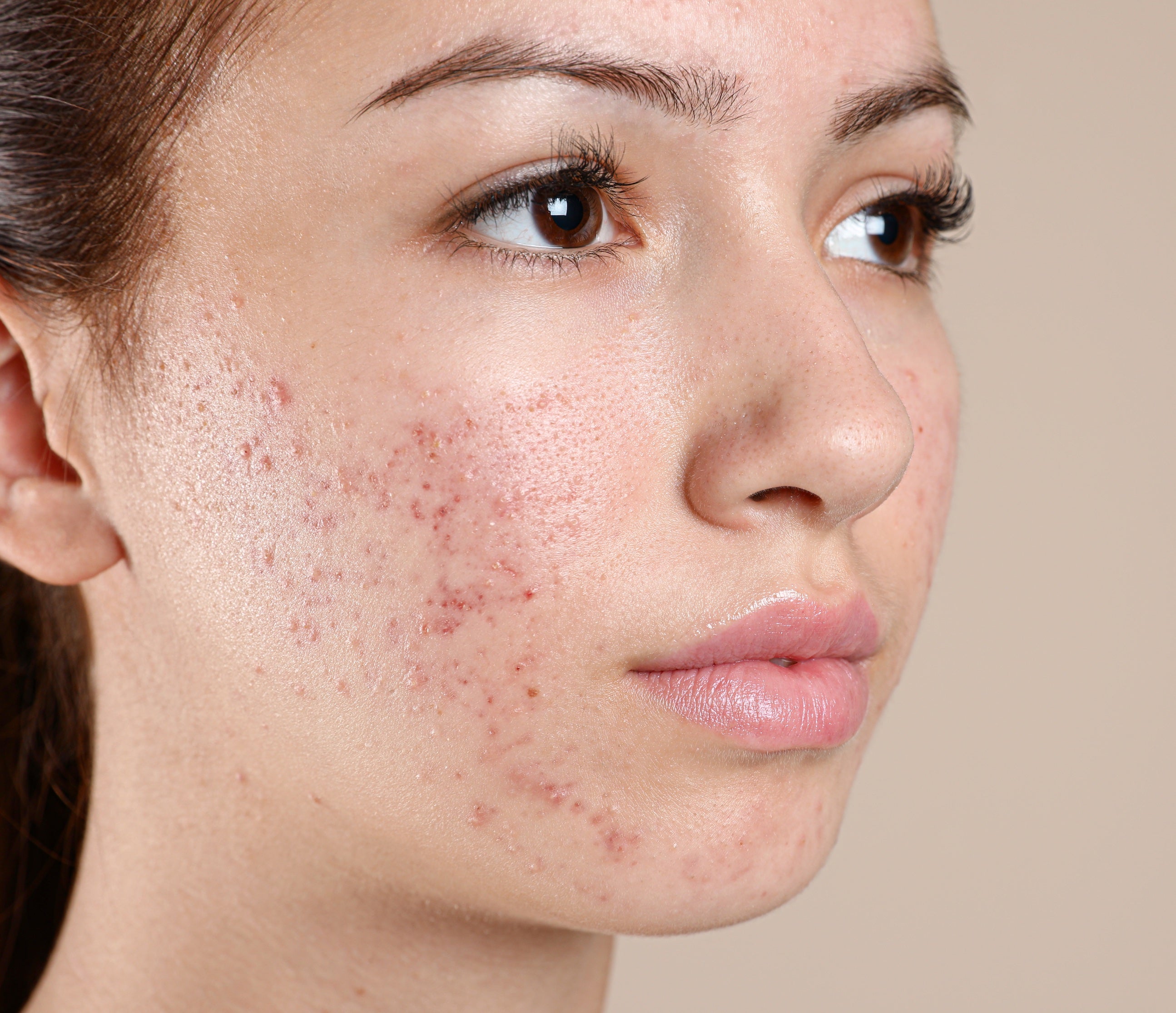 Decoding Acne: Identifying What Type and Rescue Tactics